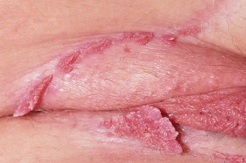 Бородавки на статевих органах жінок. Причини появи і лікування