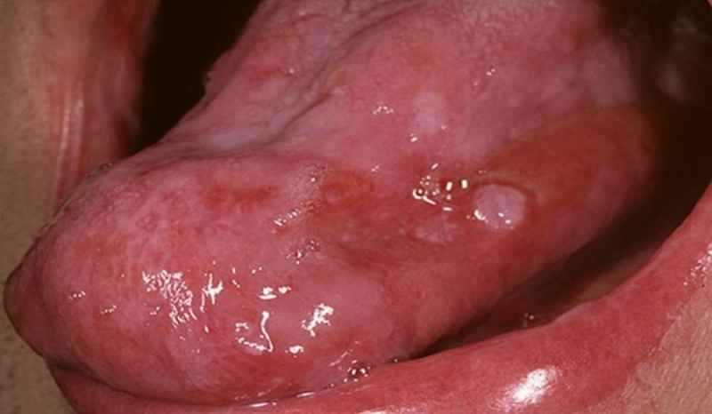 Кондиломи у роті, на язиці і губах: лікування і видалення