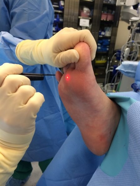Лікування бородавок між пальцями ніг