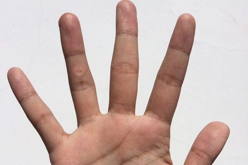 Куряча жопка на пальці руки. Причини утворення і лікування
