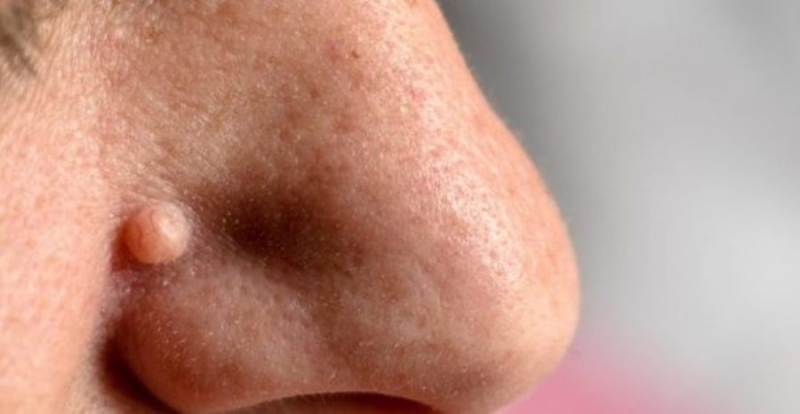 Папілома в носі, інвертована порожнини носа і її лікування