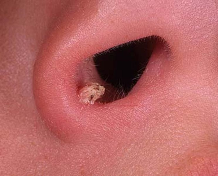 Папілома в носі, інвертована порожнини носа і її лікування