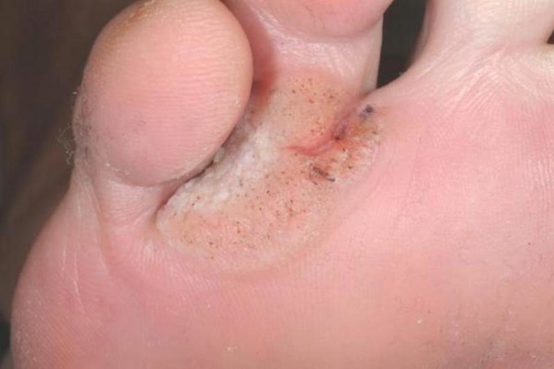 Лікування бородавок між пальцями ніг