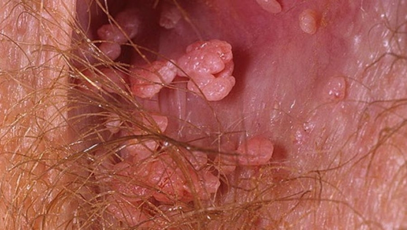 Бородавки на статевих органах жінок. Причини появи і лікування