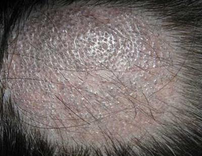 Грибок кожи головы: как распознать и лечить