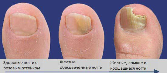 Грибок ногтей на ногах: как организовать лечение в домашних условиях современными средствами