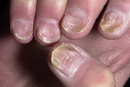 Симптомы и лечение грибка ногтей на руках (онихомикоза)